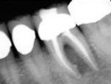 root canal