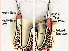 periodontal