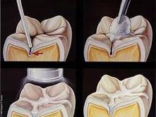 dental sealants